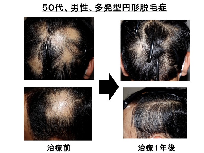 円形脱毛症　病院